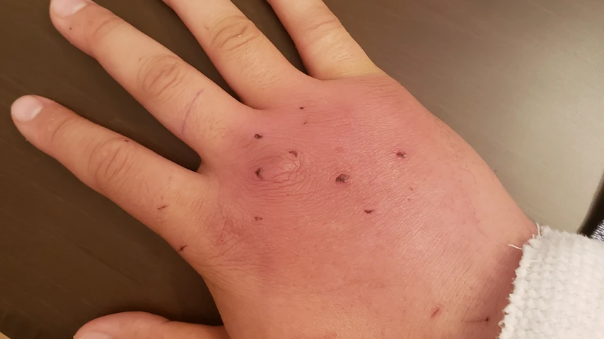 Swollen hand with infected cat bite